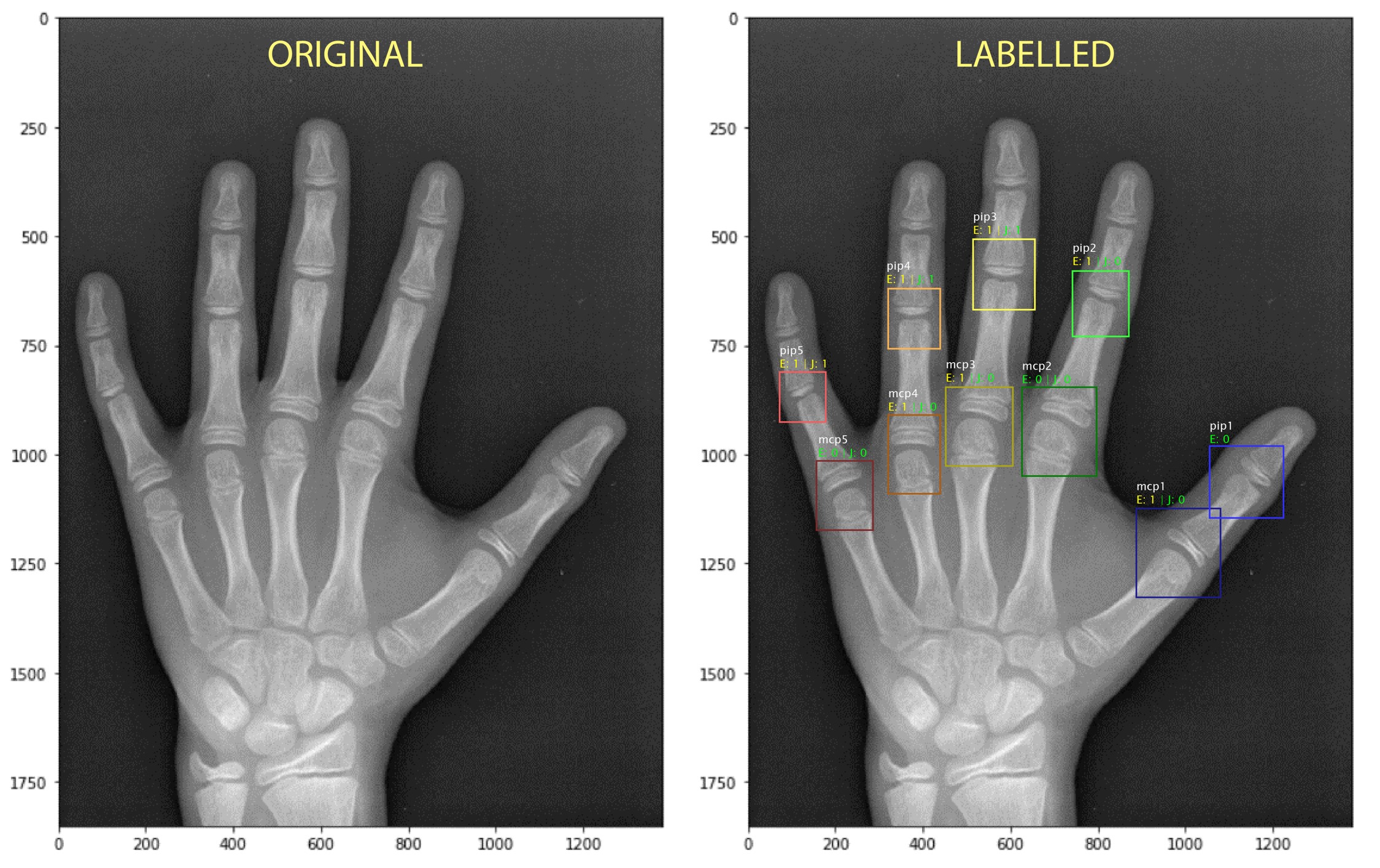 Intelligent scoring of Rheumatoid Arthritis joints in minutes